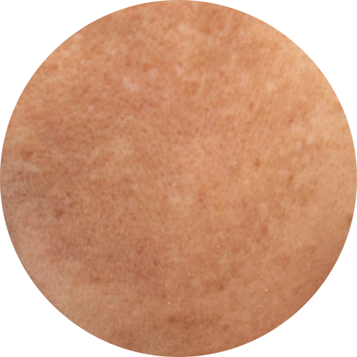 imagen de piel visualizando manchas de malasma