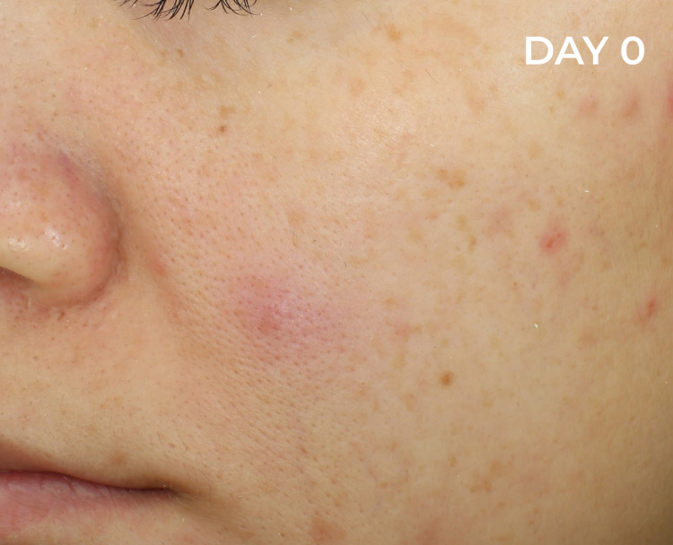 Before picture of oily and acne prone skin with blemishes