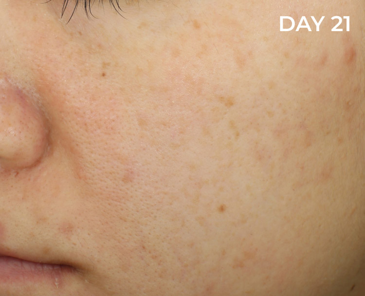After picture of oily and acne prone skin with a clearer appearence