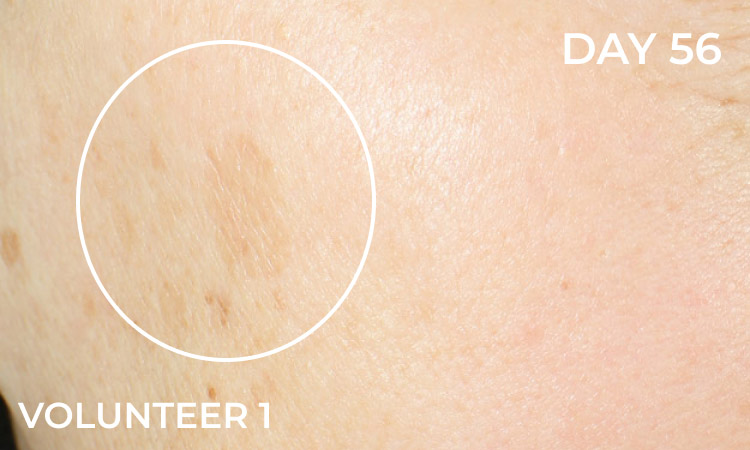Reduction in dark spots before