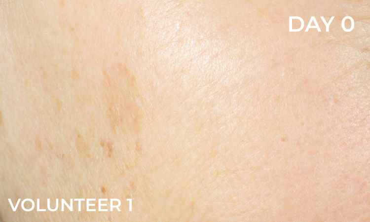 Reduction in dark spots before
