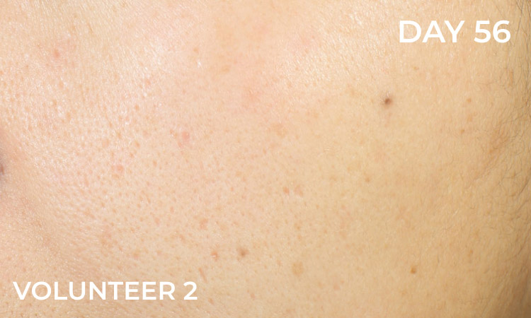 Reduction in dark spots after