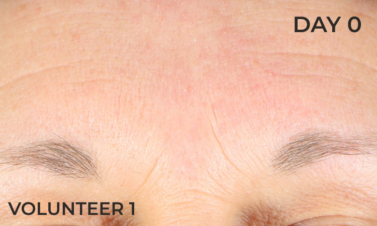 Reduction in forehead wrinkles before