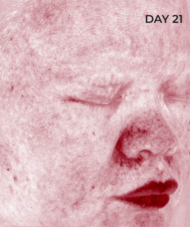 After picture of skin prone to redness