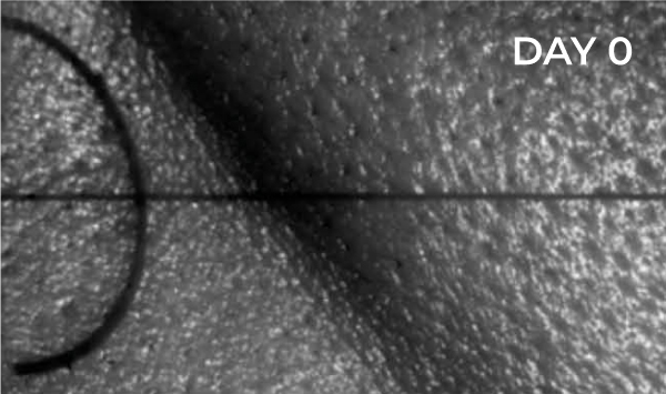 Reduction in nasolabial fold before